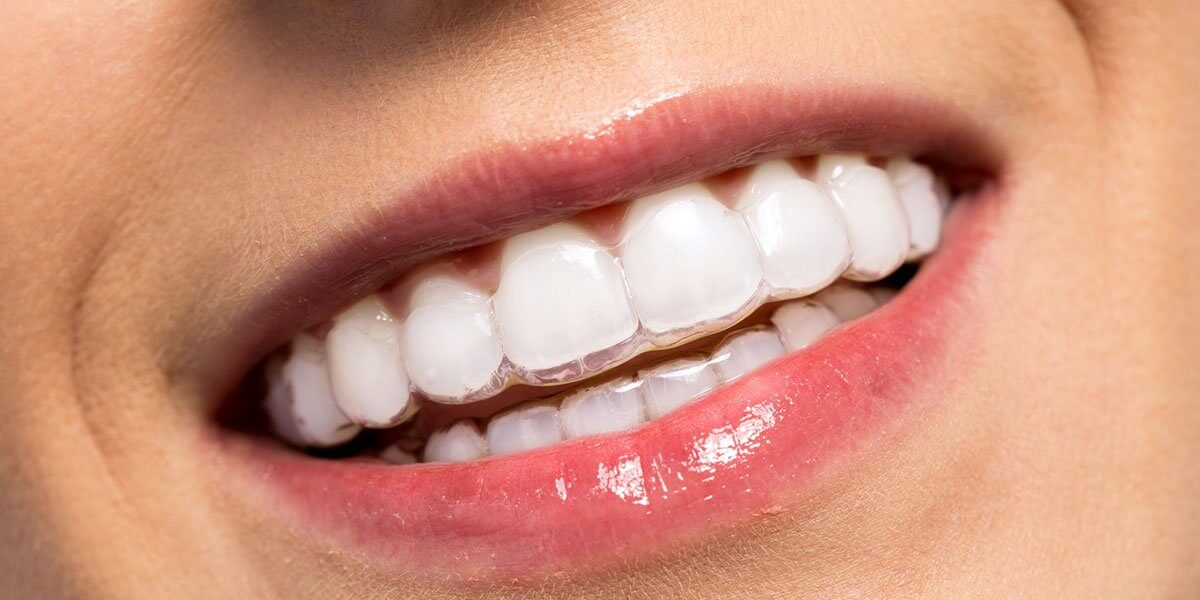 How Much Do Clear Braces Cost in White Bear Lake, MN?